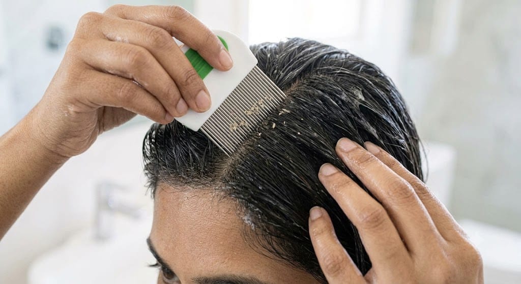 Removing lice and nits with fine lice comb after shampoo treatment