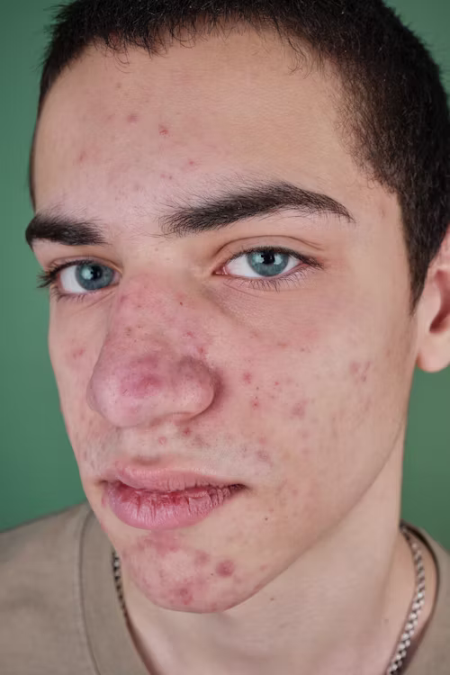 Best Acne Treatment in Pakistan (2026 Complete Guide)